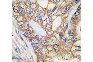 IHC analysis of FFPE human lung carcinoma tissue stained with Ihh antibody (Indian Hedgehog Antikörper  (AA 1-30))
