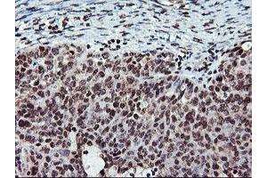 Immunohistochemical staining of paraffin-embedded Adenocarcinoma of Human ovary tissue using anti-TPSG1 mouse monoclonal antibody. (TPSG1 Antikörper  (AA 20-283))