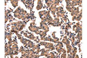 The image on the left is immunohistochemistry of paraffin-embedded Human breast cancer tissue using ABIN7128927(CGA Antibody) at dilution 1/65, on the right is treated with fusion protein. (CGA Antikörper)