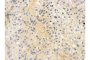 ABIN6259931 and ABIN6276398 at 1/100 staining human hepatocellular carcinoma by IHC-P.