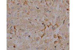 Immunohistochemical staining of human liver cancer tissue section with CAPZA1 monoclonal antibody, clone 2  at 1:100 dilution. (CAPZA1 Antikörper)