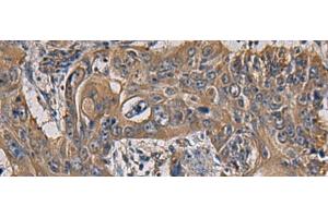Immunohistochemistry of paraffin-embedded Human esophagus cancer tissue using CCNI Polyclonal Antibody at dilution of 1:65(x200) (Cyclin I Antikörper)