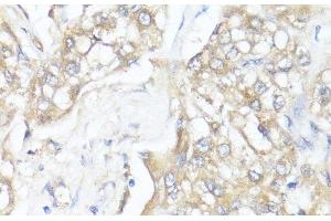 Immunohistochemistry of paraffin-embedded Human liver cancer using SMAD7 Polyclonal Antibody at dilution of 1:100 (40x lens). (SMAD7 Antikörper)