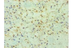 Immunohistochemistry of paraffin-embedded human breast cancer using ABIN7165066 at dilution of 1:100 (PRMT2 Antikörper  (AA 1-300))