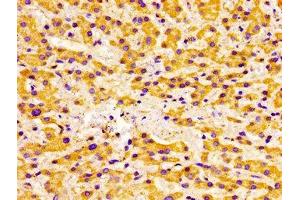 Immunohistochemistry of paraffin-embedded human liver cancer using ABIN7175433 at dilution of 1:100 (ACADVL Antikörper  (AA 403-497))