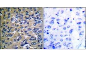 Immunohistochemistry analysis of paraffin-embedded human breast carcinoma, using IkappaB-epsilon (Phospho-Ser22) Antibody. (IkappaB-epsilon Antikörper  (pSer22))