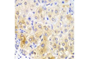Immunohistochemistry of paraffin-embedded human liver cancer using FASN antibody at dilution of 1:100 (400x lens). (Fatty Acid Synthase Antikörper)