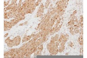 IHC-P Image Immunohistochemical analysis of paraffin-embedded human breast cancer, using Protease Inhibitor 15, antibody at 1:250 dilution.
