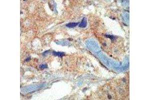 IHC analysis of FFPE human breast carcinoma tissue stained with the FLT3 antibody (FLT3 Antikörper  (AA 33-64))