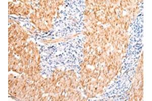 The image on the left is immunohistochemistry of paraffin-embedded Human gastric cancer tissue using ABIN7190483(DMBT1 Antibody) at dilution 1/20, on the right is treated with synthetic peptide. (DMBT1 Antikörper)