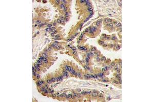 Formalin-fixed and paraffin-embedded human lung carcinoma tissue reacted with Bmp6 antibody (N-term) (ABIN388456 and ABIN2848818) , which was peroxidase-conjugated to the secondary antibody, followed by DAB staining. (BMP6 Antikörper  (N-Term))