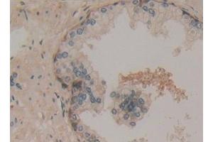 Detection of 0 in Human Prostate Tissue using Polyclonal Antibody to Superoxide Dismutase Copper Chaperone (Superoxide dismutase copper chaperone Antikörper  (AA 23-269))