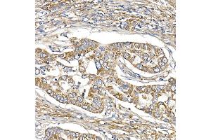Immunohistochemistry of paraffin-embedded human lung cancer using S Rabbit mAb (ABIN7270501) at dilution of 1:250 (40x lens).