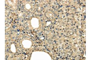 The image on the left is immunohistochemistry of paraffin-embedded Human thyroid cancer tissue using ABIN7128055(UBE2B Antibody) at dilution 1/30, on the right is treated with fusion protein. (UBE2B Antikörper)