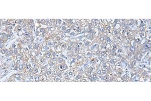 Immunohistochemistry of paraffin-embedded Human liver cancer tissue using TREM1 Polyclonal Antibody at dilution of 1:50(x200) (TREM1 Antikörper)