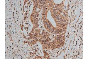 ABIN6268858 at 1/50 staining human colon cancer tissue sections by IHC-P. (MCL-1 Antikörper  (Internal Region))