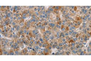 Immunohistochemistry of paraffin-embedded Human liver cancer using DBH Polyclonal Antibody at dilution of 1:70 (DBH Antikörper)