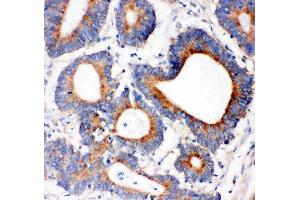 Anti-IRS1 antibody, (ABIN3043251), IHC(P)IHC(P): Human Intestinal Cancer Tissue (IRS1 Antikörper  (AA 1041-1242))