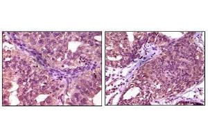 Immunohistochemical analysis of paraffin-embedded human ovary carcinoma (left) and breast carcinoma (right), showing cytoplasmic localization using EphA1 mouse mAb with DAB staining.