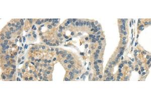 Immunohistochemistry of paraffin-embedded Human thyroid cancer tissue using CCL13 Polyclonal Antibody at dilution 1:40 (CCL13 Antikörper)