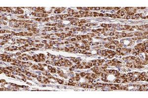 ABIN6279850 at 1/100 staining Human liver cancer tissue by IHC-P. (SLC28A1 Antikörper  (N-Term))