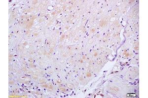 Formalin-fixed and paraffin embedded human gastric carcinoma tissue labeled with Anti ROCK2 Polyclonal Antibody, unconjugated (ABIN673359) at 1:200 followed by incubation with conjugated secondary antibody and DAB staining (ROCK2 Antikörper  (AA 1001-1300))