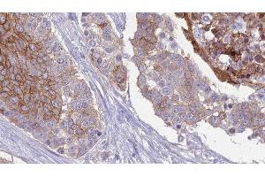 ABIN6277181 at 1/100 staining Human urothelial cancer tissue by IHC-P.