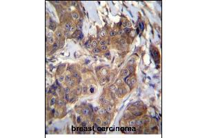 ATP6V1B1 Antibody (C-term) (ABIN656224 and ABIN2845541) immunohistochemistry analysis in formalin fixed and paraffin embedded human breast carcinoma followed by peroxidase conjugation of the secondary antibody and DAB staining. (ATP6V1B1 Antikörper  (C-Term))