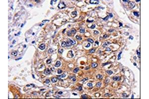 The image is immunohistochemistry of paraffin-embedded Human liver cancer tissue using (ALK Antibody) at dilution 1/25. (ALK Antikörper)