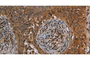 Immunohistochemistry of paraffin-embedded Human cervical cancer tissue using OSM Polyclonal Antibody at dilution 1:40 (Oncostatin M Antikörper)