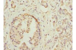 Immunohistochemistry of paraffin-embedded human pancreatic cancer using ABIN7155761 at dilution of 1:100 (HOXD1 Antikörper  (AA 1-240))