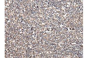 The image on the left is immunohistochemistry of paraffin-embedded Human tonsil tissue using ABIN7128064(UGGT2 Antibody) at dilution 1/20, on the right is treated with fusion protein. (UGCGL2 Antikörper)