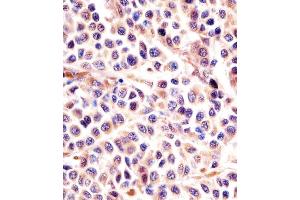(ABIN6242397 and ABIN6578004) staining IL24 in human melanoma sections by Immunohistochemistry (IHC-P - paraformaldehyde-fixed, paraffin-embedded sections). (IL-24 Antikörper)