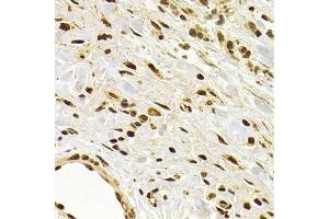 Immunohistochemistry of paraffin-embedded human stomach cancer using DNMT3A antibody at dilution of 1:200 (400x lens). (DNMT3A Antikörper)