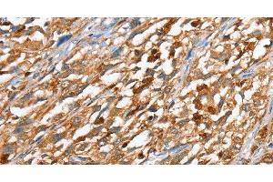 Immunohistochemistry of paraffin-embedded Human esophagus cancer using CAPG Polyclonal Antibody at dilution of 1:40 (CAPG Antikörper)