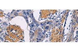 Immunohistochemistry of paraffin-embedded Human esophagus cancer tissue using FAM20C Polyclonal Antibody at dilution of 1:45(x200) (FAM20C Antikörper)