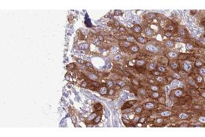 ABIN6276987 at 1/100 staining Human Head and neck cancer tissue by IHC-P. (HVEM Antikörper  (C-Term))
