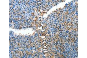 Immunohistochemical analysis of paraffin-embedded Human liver cancer tissue using at dilution 1/25. (ALPK1 Antikörper  (C-Term))