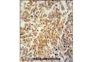 TEX9 antibody (N-term) (ABIN654569 and ABIN2844274) immunohistochemistry analysis in formalin fixed and paraffin embedded human testis carcinoma followed by peroxidase conjugation of the secondary antibody and DAB staining. (TEX9 Antikörper  (N-Term))