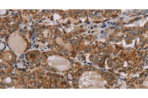 Immunohistochemistry of paraffin-embedded Human thyroid cancer tissue using MT-ND6 Polyclonal Antibody at dilution 1:40 (MT-ND6 Antikörper)