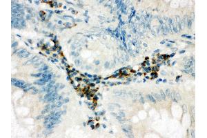 Anti-SPARCL1 antibody, IHC(P) IHC(P): Human Intestinal Cancer Tissue (SPARCL1 Antikörper  (C-Term))