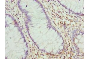Immunohistochemistry of paraffin-embedded human colon cancer using ABIN7168234 at dilution of 1:100 (RING1 Antikörper  (AA 401-630))
