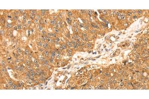 Immunohistochemistry of paraffin-embedded Human breast cancer using ERK 5 Polyclonal Antibody at dilution of 1:35 (MAPK7 Antikörper)
