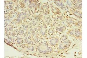 Immunohistochemistry of paraffin-embedded human breast cancer using ABIN7143952 at dilution of 1:100 (ABHD14A Antikörper  (AA 56-258))