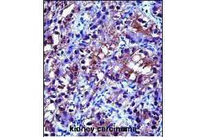 CRYA Antibody (Center) (ABIN657620 and ABIN2846616) immunohistochemistry analysis in formalin fixed and paraffin embedded human kidney carcinoma followed by peroxidase conjugation of the secondary antibody and DAB staining. (CRYAB Antikörper  (AA 84-112))