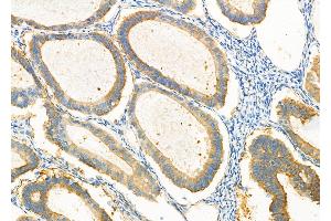 ABIN6265225 and ABIN6277101 at 1/100 staining human ovarian cancer by IHC-P.