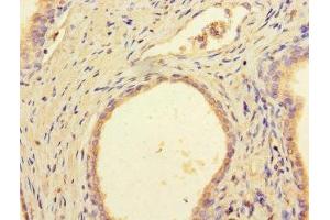 Immunohistochemistry of paraffin-embedded human prostate cancer using ABIN7149526 at dilution of 1:100 (DCAF8 Antikörper  (AA 1-135))
