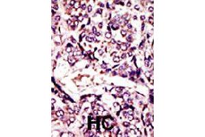 Formalin-fixed and paraffin-embedded human hepatocellular carcinoma tissue reacted with ARL1 polyclonal antibody  , which was peroxidase-conjugated to the secondary antibody, followed by DAB staining . (ARL1 Antikörper  (N-Term))