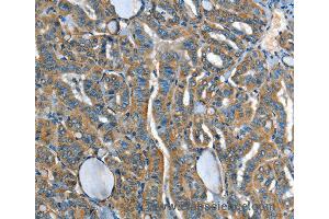 Immunohistochemistry of Human liver cancer using ADCY4 Polyclonal Antibody at dilution of 1:45 (ADCY4 Antikörper)