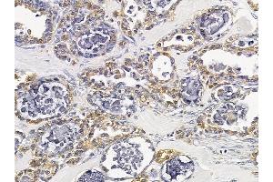 TRIM59 Mouse Monoclonal Antibody at 1/100 staining human ovarian cancer by IHC-P.
